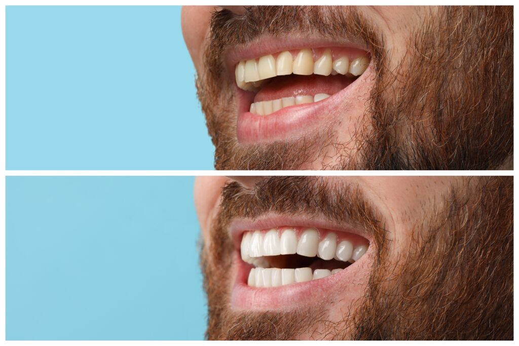 How Dental Bonding Can Quickly Improve Your Smile