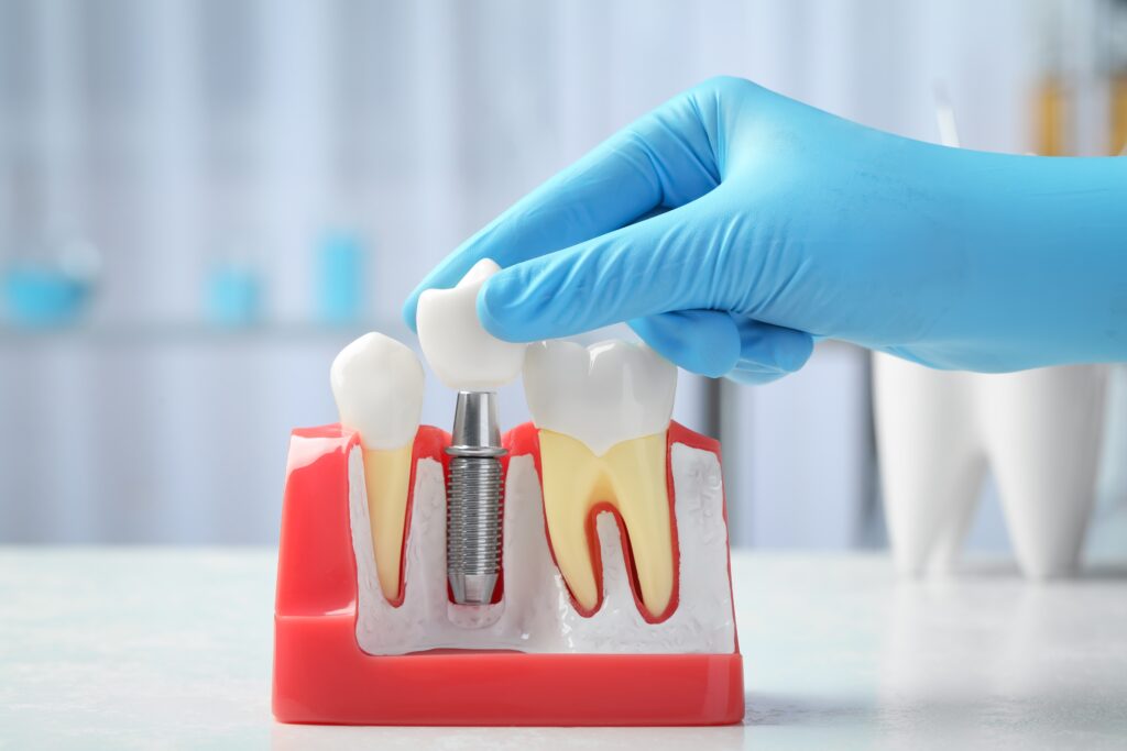 Dentist,Putting,Crown,Onto,Abutment,Of,Dental,Implant,Between,Teeth
